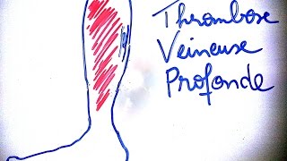 SmartNEasy  Thrombose veineuse profonde  Dr Astuce [upl. by Amir]