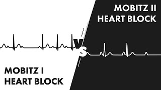 Mobitz Type I vs Type II Second Degree Heart Block [upl. by Norry]