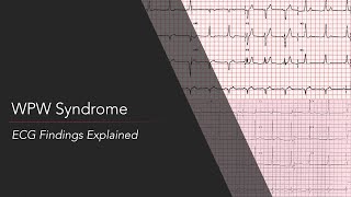 WolffParkinsonWhite WPW Syndrome ECG [upl. by Adile934]