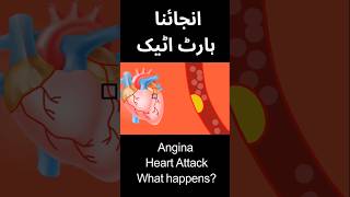 Angina vs heart attack [upl. by Odlabso]