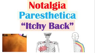 Notalgia Paresthetica “Itchy Back”  Causes Risk Factors Symptoms Diagnosis Treatment [upl. by Burnight]