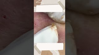 Big Cystic Acne Blackheads Extraction Blackheads amp Milia Whiteheads Removal Pimple Popping [upl. by Heiner]