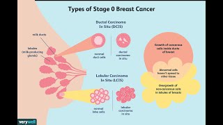 Treatment of Ductal Carcinoma in Situ [upl. by Viridi]