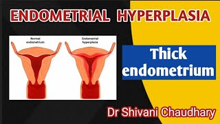 Endometrial hyperplasia  Thick endometrium heavybleeding uterus [upl. by Arol]