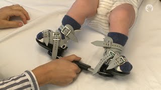 Clubfoot Stretches  Ponseti Brace  Module 4 [upl. by Allemap]