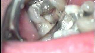 endocoronal access of lower molar [upl. by Manno922]