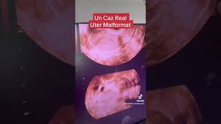 Un Caz Real Uter Malformat [upl. by Aryamo]