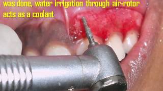 Gingival Depigmentation Procedure Using Diamond Bur Case By Dr Akash Akinwar [upl. by Regan427]