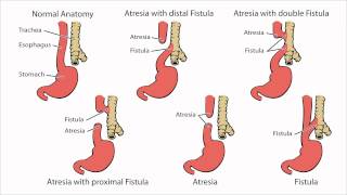 Esophageal Atresia  What is Esophageal Atresia [upl. by Kurtzman16]