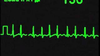 Atrial Fibrillation  AFIB  ECG Simulator  Arrhythmia Simulator [upl. by Grimes]