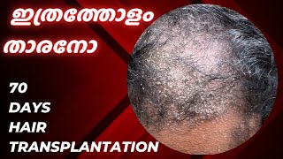 Hair transplantation after 70 days  ഈ താരൻ കൊണ്ട് ഞാൻ കുടുങ്ങി  safvan pullara [upl. by Drucy178]