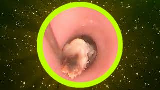 Earwax and clean the ear part 10 [upl. by Verbenia]