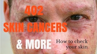 How to spot skin cancers [upl. by Small]