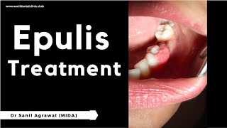 Gingival Enlargement  Epulis  Treatment  Dr Sanil Agrawal [upl. by Coke]