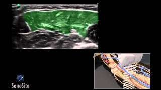 How To Ultrasound Guided Median and Ulnar Nerve Block 3D Video [upl. by Aikan]