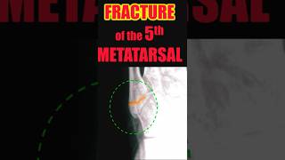 Fracture of the 5th Metatarsal trauma radiology doctor [upl. by Mayor]