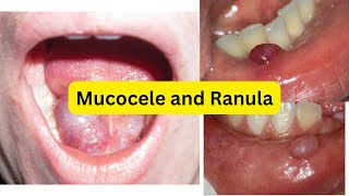 Mucocele VS Ranula EASY [upl. by Choo]