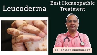 Leucoderma  सफेद दाग Best Homeopathic Treatment [upl. by Susanetta727]