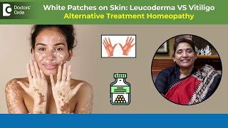 WHITE PATCHES on Skin Leucoderma VS Vitiligo Homeopathy TreatmentDrSurekha TiwariDoctors Circle [upl. by Sumerlin]