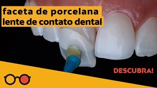 Lentes de contato dental dói para colocar Como é o desgaste nos dentes para faceta de porcelana [upl. by Anneliese]