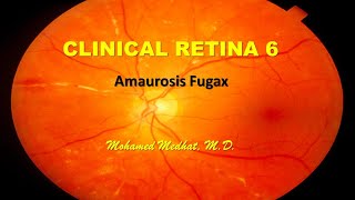 Clinical Retina 6  Amaurosis Fugax [upl. by Ocirderf789]