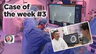 Case of the week 3  CTPerfusion and ADAPTQUATTRO for MeVO occlusions [upl. by Finlay794]