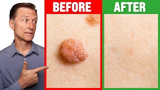 How to Rid Skin Tags and Warts Within 24 Hours  Dr Berg on Skin Tag Removal [upl. by Oyam]