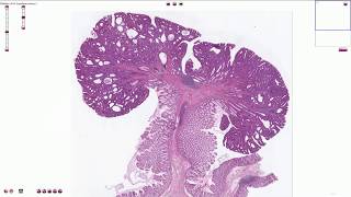 Tubular adenoma  Colon  Histopathology [upl. by Buffum775]