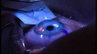 Laser Eye Surgery  The Patient Experience at London Vision Clinic on Harley St London [upl. by Yllut]