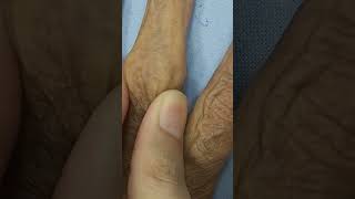 Bouchard Nodes  Pip joint  Osteoarthritis  Bony outgrowths clinicalskills [upl. by Blaine]