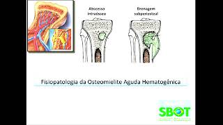 Osteomielite Aguda Hematogênica e Artrite Séptica Dr José Luís Amim Zabeu [upl. by Cheyne806]