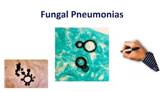 Fungal Pneumonia Made Simple [upl. by Antrim]