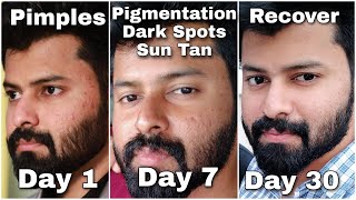 Do you have Dark Spots Pigmentation Just follow this for 100  gauranteed Result 👍  Tamil [upl. by Nylteak981]