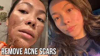 First Chemical Peel Experience  Results Before amp After [upl. by Nnadroj317]