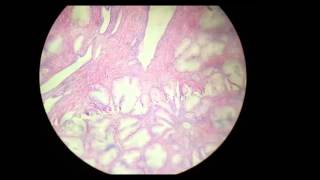 Benign prostatic hyperplasia histopathology [upl. by Eelarol]