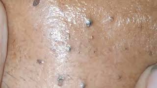 sac dep spa blackheads elderly 2023  sac dep spa blackheads new  skin cyst treatments 2023 [upl. by Nnodnarb]