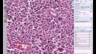 Medical School Pathology 2013 Season Session 34 EndocrineIV Lab [upl. by Lynch]