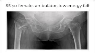 Fixation of intertrochanteric femur fractures SHS vs nail  Debate [upl. by Bollay]