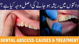 DENTAL ABSCESS  Dant Ka Infection  Peep Ka Ban Jana  Dant Me Resha Hona  PUS In Teeth Causes [upl. by Clayberg]