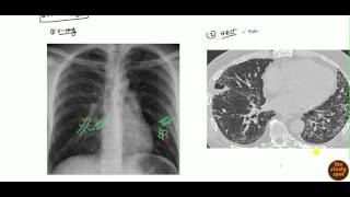 Bronchiectasis for USMLE [upl. by Sinai21]