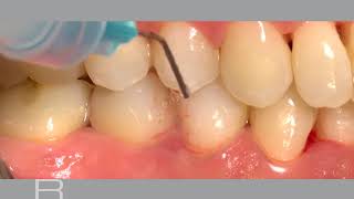 Nonsurgical treatment of periodontitis and periimplant mucositis [upl. by Antonin]