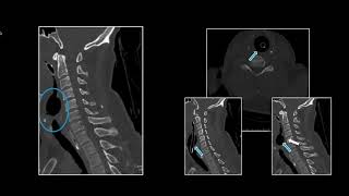 Endotracheal Intubation Pt 1  Free Radiology CME [upl. by Swanhildas]