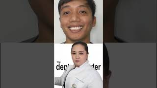 Conservative Dentistry SAYING quotNO quot to jacket crown FACEBOOK  THE DENTAL CENTER MANILA [upl. by Eivod]