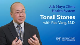 All About Tonsil Stones Ask Mayo Clinic Health System [upl. by Niuq]