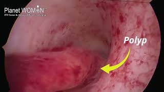 Hysteroscopic Polypectomy I Dr Mehul Damani I Planet WOMEN [upl. by Ecylla723]