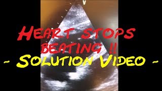 Cardiology Echo QuizCase Heart stops beating Part 2 Solution video [upl. by Atterbury]