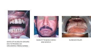 Oral Submucous Fibrosis [upl. by Adnahsed256]