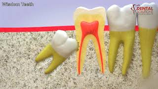 All you need to know about the eruption of a wisdom tooth [upl. by Jecoa]