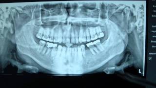 Mandible Fracture Panoramic Radiograph [upl. by Bamberger]