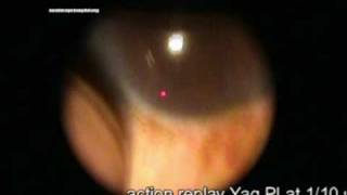 laser iridotomy for angle closure glaucoma [upl. by Inor164]